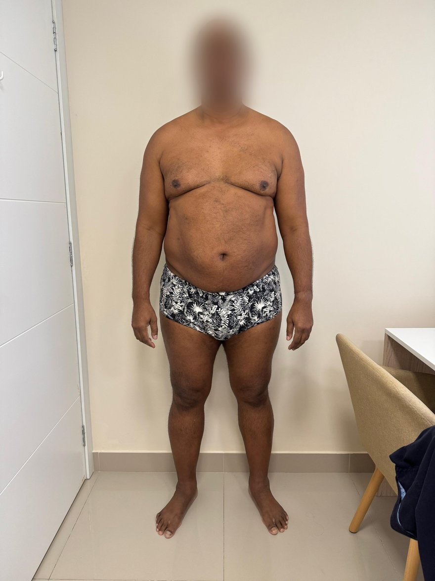 Antes: Evolução corporal de paciente em acompanhamento nutricional, vista frontal