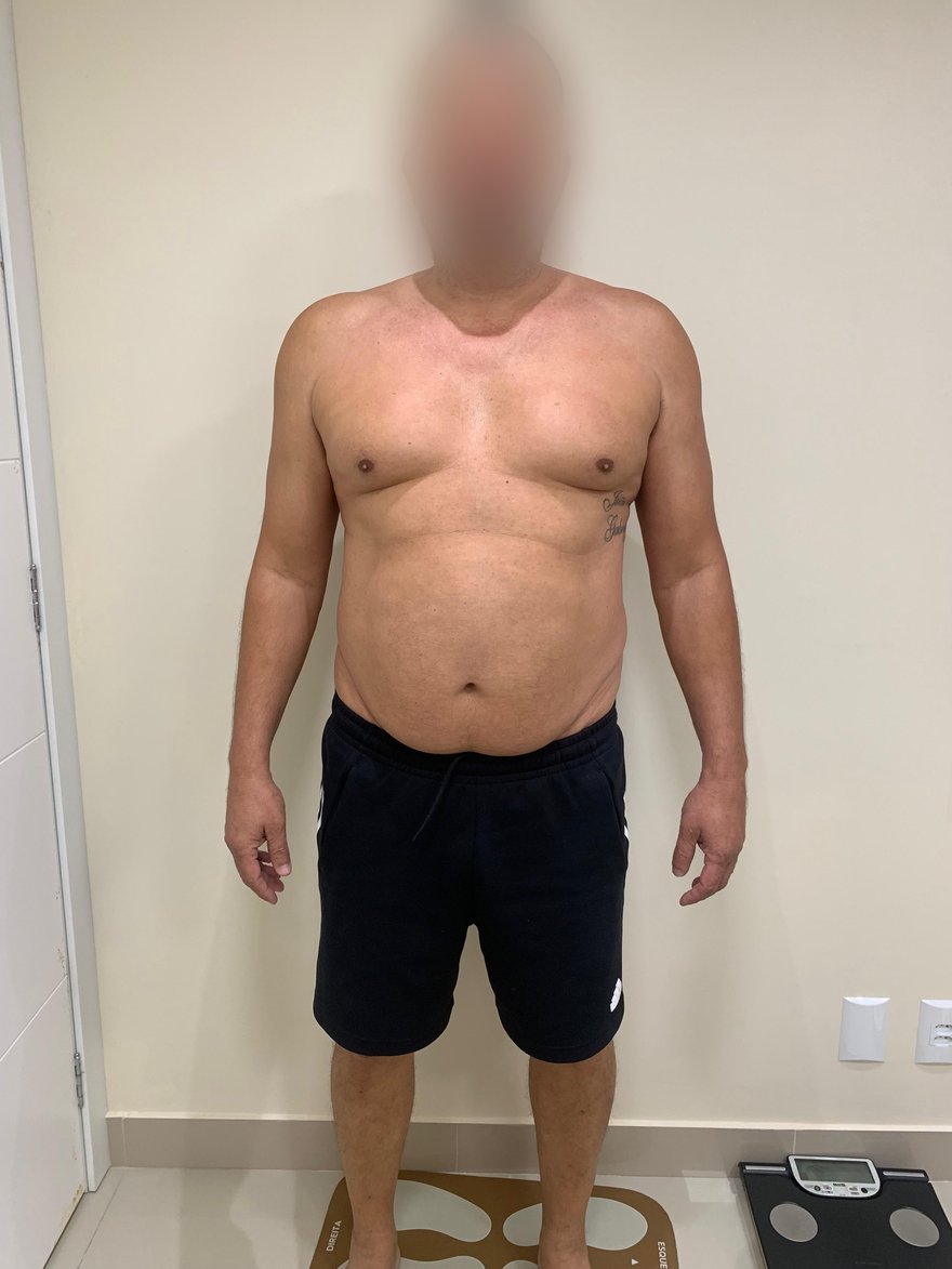 Antes: Evolução corporal de paciente em acompanhamento nutricional, vista frontal