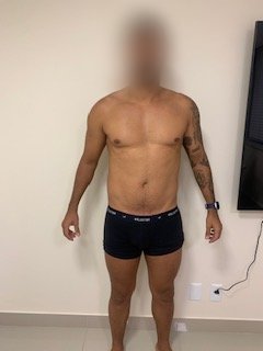 Antes: Evolução corporal de paciente em acompanhamento nutricional, vista frontal